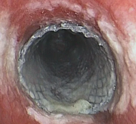 Bronchi