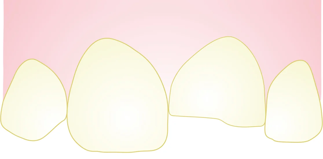 Drawing of a broken tooth