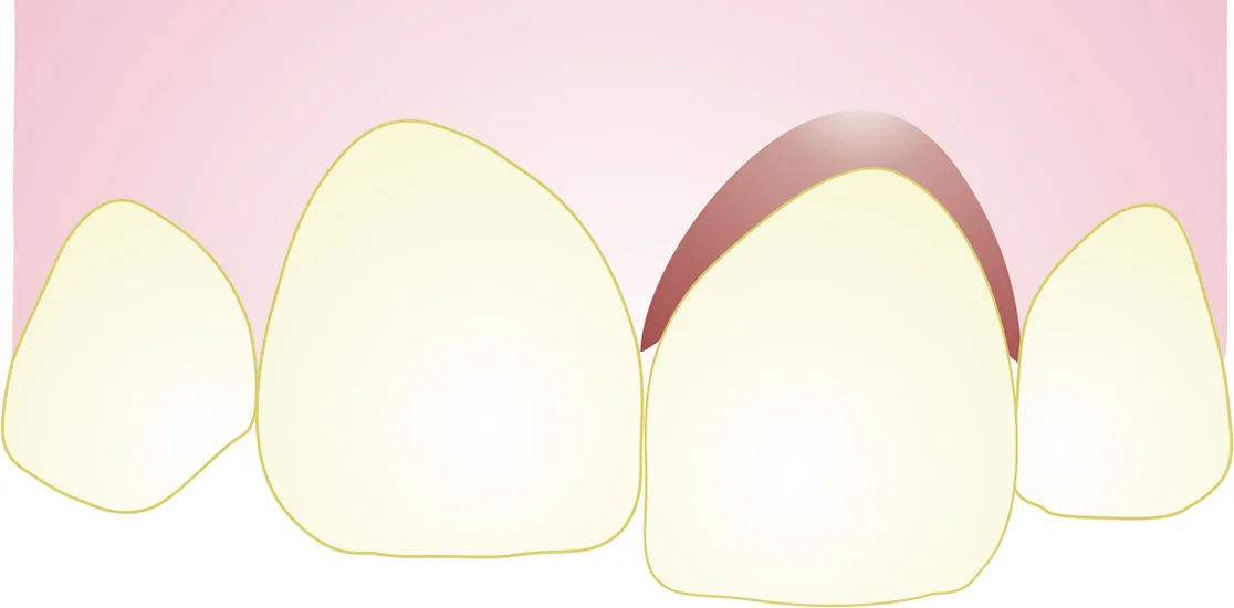 Drawing of a displaced tooth