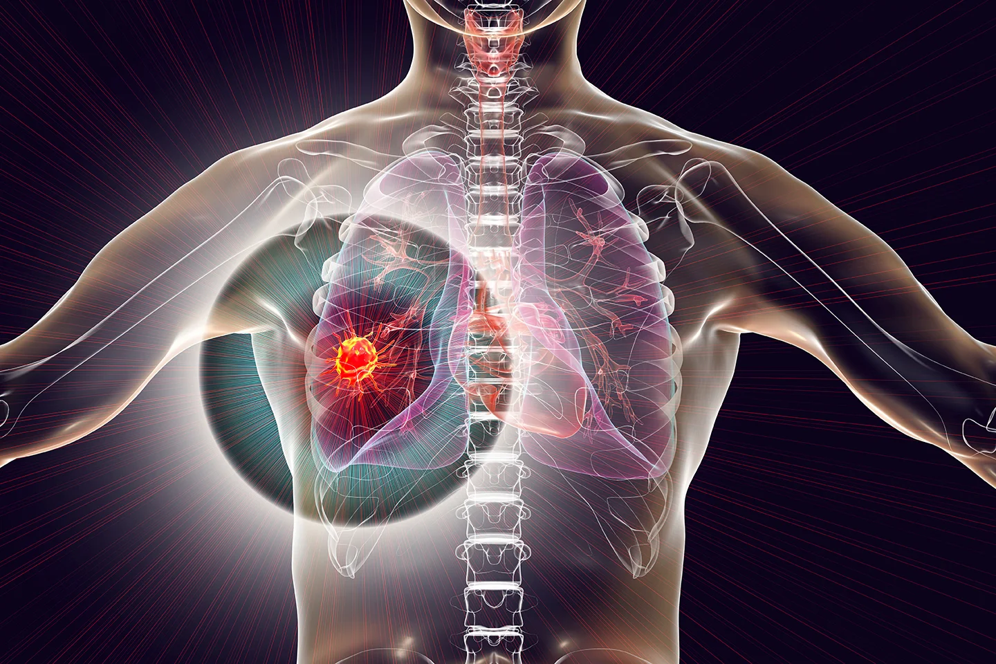 Lung cancer, 3D illustration