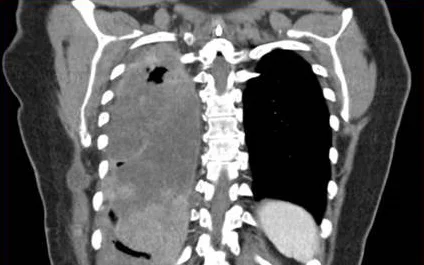 MRI NUT carcinoma